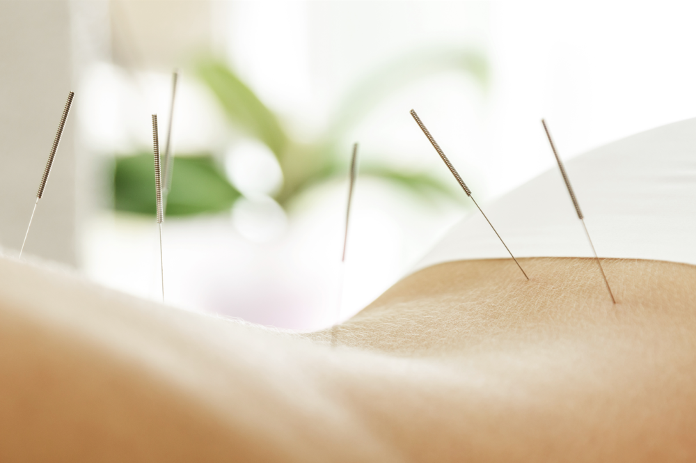 acupuncture à Lanester